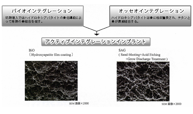 POINT3：薄膜HAコーティングインプラントによる治療期間の短縮