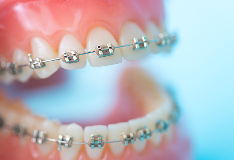 矯正開始時期は乳歯と永久歯の混合期がベスト