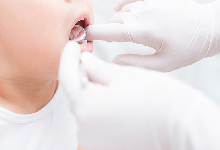 シーラントによる虫歯予防処置