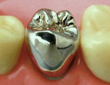 銀歯（保険適用治療）
